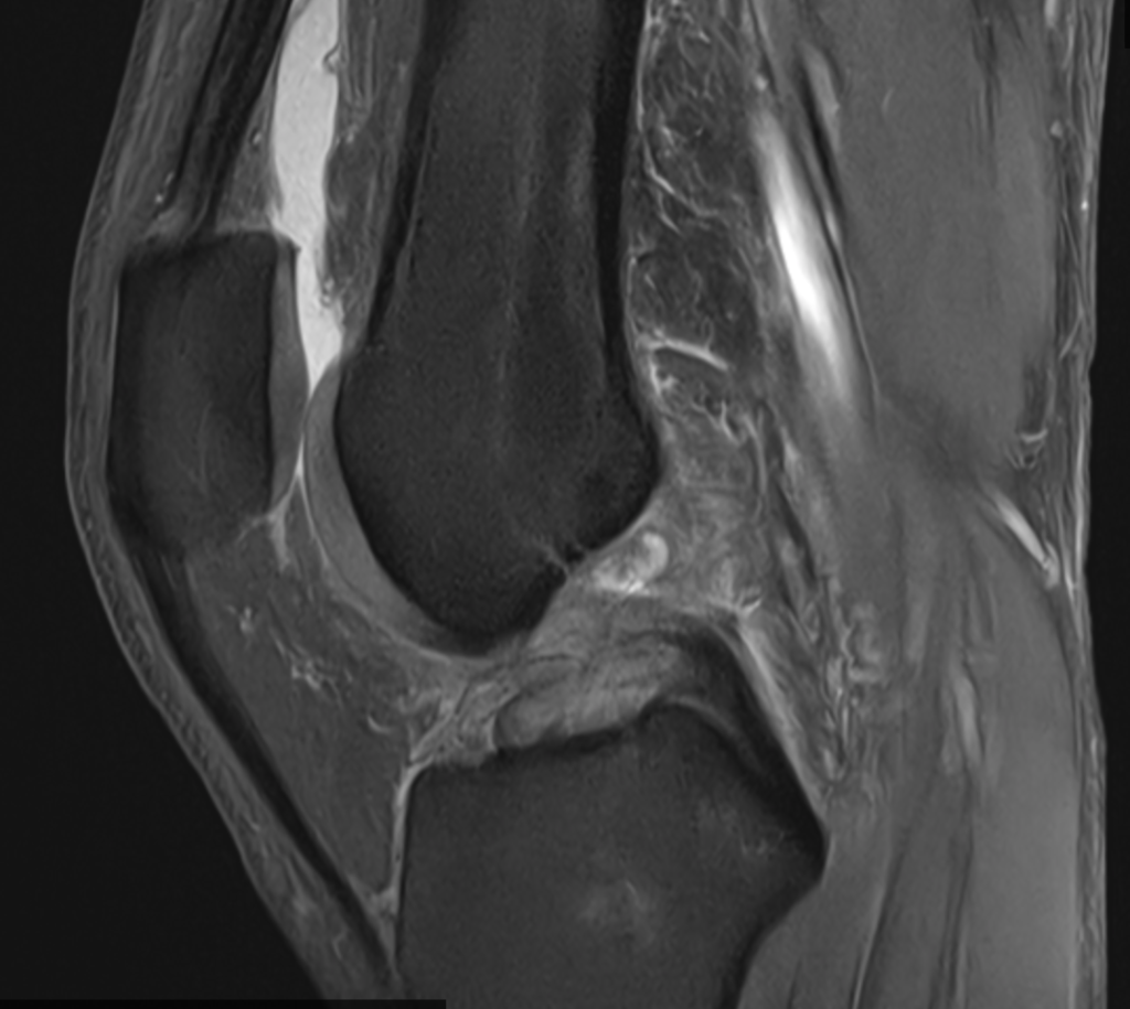 ligamento cruzado anterior - lca