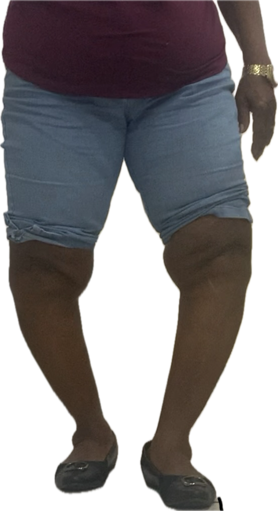 artrose do joelho
